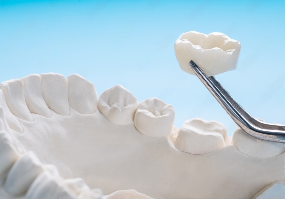 Understanding Dental Crowns: A Key to Restorative Dentistry at Montgomery Dental MD